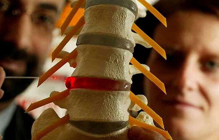 Changes in the integrity of the intervertebral records