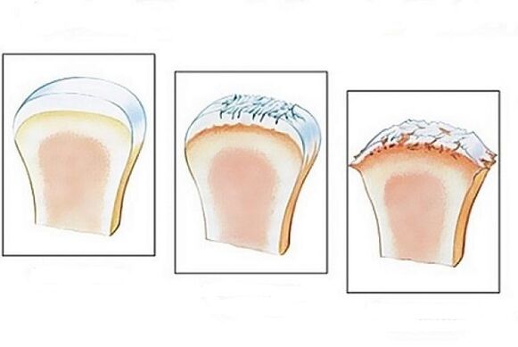 joint damage in the different stages of the development of arthrosis