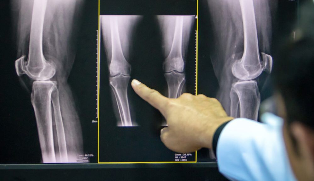 knee x-ray arthrosis