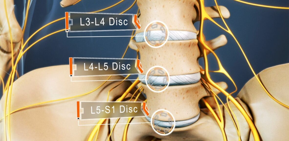 Disks of the lumbar spine, which are most often affected by osteochondrosis