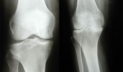 Knee diagnosis methods