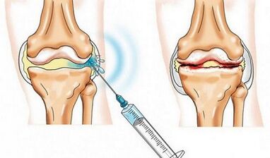 The blocking of the knee joint for arthrosis