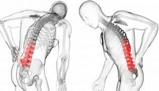 Intervertebral hernia - complication with osteochondosis