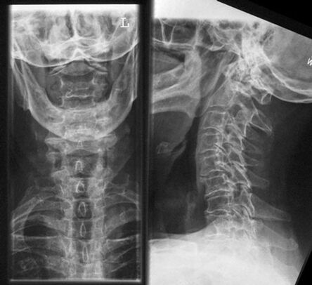 Cervical X -Ray - Method of diagnosis of osteochondosis