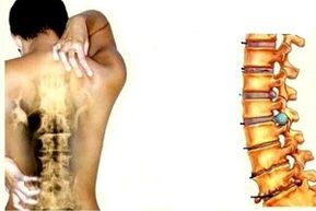 Back pain in different stages of the development of cervical osteochondosis
