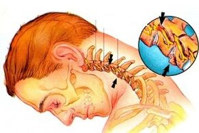 Nervo pinving in the spine with cervical osteochondosis