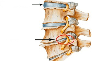 Normal and damaged spinal disk with cervical osteochondrosis