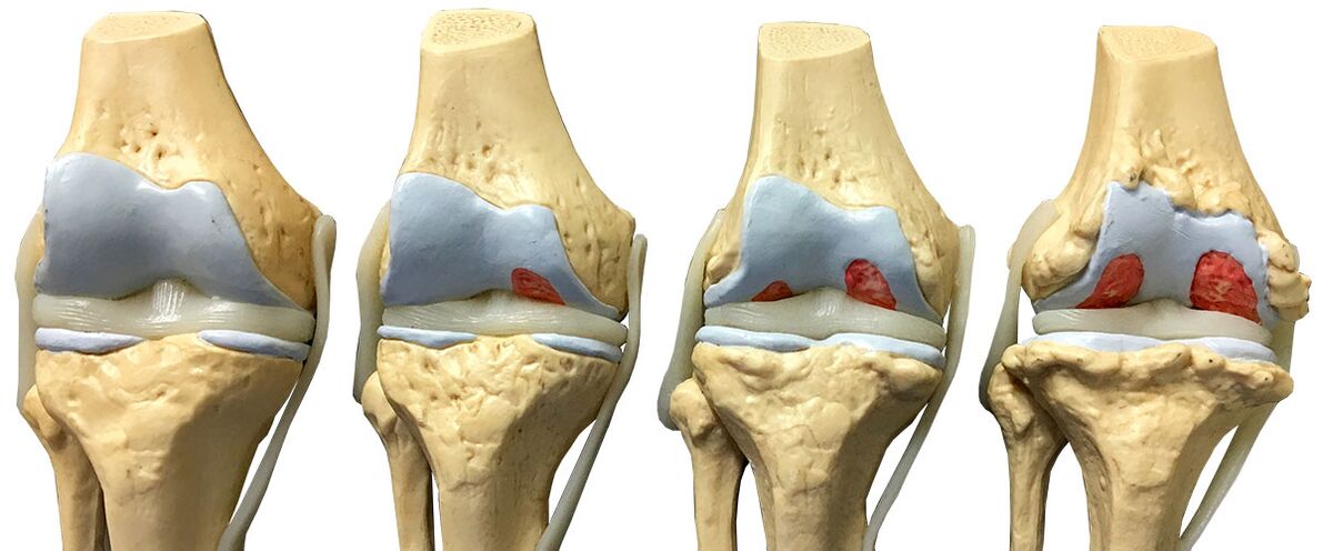 stages of osteoarthritis